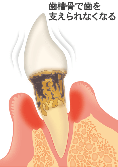 重度歯周炎（歯槽骨で歯を支えられなくなる）